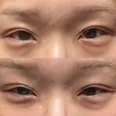 ヒアルロン酸注入（涙袋） 小倉美容外科/美容皮膚科 ビラビューティークリニック DAY 1 サムネイル用