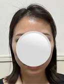 糸リフト / ボトックス（エラ・小顔） アリエル美容クリニック 水戸院 DAY 23 サムネイル用