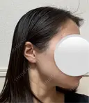 糸リフト / ボトックス（エラ・小顔） アリエル美容クリニック 水戸院 DAY 23 サムネイル用