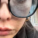 ピコレーザートーニング（美白・肝斑） / ピコフラクショナルレーザー（毛穴・ニキビ跡） しんゆり美容健康クリニック DAY 0 サムネイル用