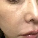 ピコレーザートーニング（美白・肝斑） / ピコフラクショナルレーザー（毛穴・ニキビ跡） しんゆり美容健康クリニック DAY 1 サムネイル用