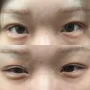 ヒアルロン酸注入（涙袋） 小倉美容外科/美容皮膚科 ビラビューティークリニック DAY 2 サムネイル用