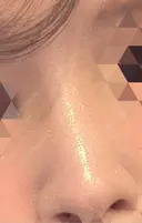 隆鼻術 形成外科と美容外科のクリニック池袋 AFTER サムネイル用