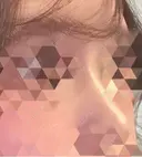 隆鼻術 形成外科と美容外科のクリニック池袋 DAY 5 サムネイル用