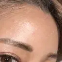 ピコレーザートーニング（美白・肝斑） / ピコフラクショナルレーザー（毛穴・ニキビ跡） しんゆり美容健康クリニック DAY 2 サムネイル用