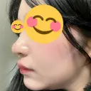 ヒアルロン酸注入（鼻） / ボトックス（人中） A CLINIC（エークリニック） 福岡院 DAY 9 サムネイル用