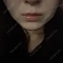 オンダリフト RIVER CLINIC（リバークリニック） AFTER サムネイル用