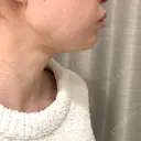 インディバ（顔） 渋谷美容外科クリニック 新橋院 DAY 2 サムネイル用