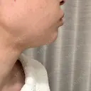 インディバ（顔） 渋谷美容外科クリニック 新橋院 DAY 3 サムネイル用