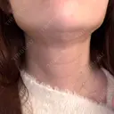 インディバ（顔） 渋谷美容外科クリニック 新橋院 DAY 5 サムネイル用