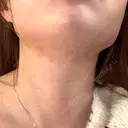 インディバ（顔） 渋谷美容外科クリニック 新橋院 DAY 6 サムネイル用