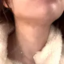 インディバ（顔） 渋谷美容外科クリニック 新橋院 DAY 8 サムネイル用