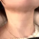 インディバ（顔） 渋谷美容外科クリニック 新橋院 AFTER サムネイル用