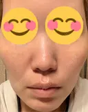 肌育注射（ジュベルックなど） 城本クリニック 豊橋院 DAY 9 サムネイル用