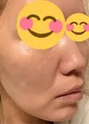 肌育注射（ジュベルックなど） 城本クリニック 豊橋院 DAY 9 サムネイル用