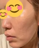 肌育注射（ジュベルックなど） 城本クリニック 豊橋院 DAY 9 サムネイル用