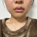 ヒアルロン酸注入（涙袋） / ボトックス（エラ・小顔） / ヒアルロン酸注入（唇） 小暮整形外科・美容外科 DAY 2 サムネイル用