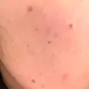 ほくろ・いぼ除去レーザー（肌） 心斎橋KT美容クリニック DAY 3 サムネイル用