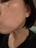 シミ取りレーザー / ピコレーザートーニング（美白・肝斑） 東京シルククリニック 東京神田院 AFTER サムネイル用