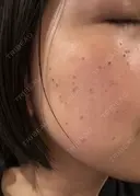 シミ取りレーザー / ピコレーザートーニング（美白・肝斑） 東京シルククリニック 東京神田院 DAY 7 サムネイル用