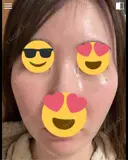 毛穴洗浄（ハイドラフェイシャルなど） / ピコレーザートーニング（美白・肝斑） 表参道ウィズ・クリニック DAY 5 サムネイル用