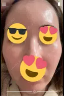 毛穴洗浄（ハイドラフェイシャルなど） / ピコレーザートーニング（美白・肝斑） 表参道ウィズ・クリニック DAY 6 サムネイル用