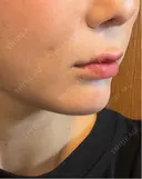 ヒアルロン酸注入（あご） 千葉美容外科アイビークリニック DAY 10 サムネイル用