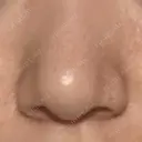 鼻尖形成（切開） リッツ美容外科 大阪院 DAY 45 サムネイル用