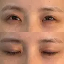 二重切開 / 眼瞼下垂（切開） / スレッドノーズ / ヒアルロン酸注入（鼻翼基部） オーキッド美容クリニック東京御徒町 DAY 492 サムネイル用