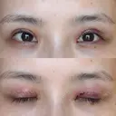 二重切開 / 眼瞼下垂（切開） / スレッドノーズ / ヒアルロン酸注入（鼻翼基部） オーキッド美容クリニック東京御徒町 DAY 493 サムネイル用