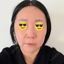 脂肪溶解注射（顔） ルラ美容クリニック 仙台院 / ルラスキンクリニック 仙台院 DAY 3 サムネイル用