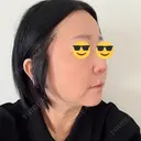 脂肪溶解注射（顔） ルラ美容クリニック 仙台院 / ルラスキンクリニック 仙台院 DAY 3 サムネイル用