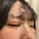 二重埋没 東京シンデレラ美容外科 池袋院 DAY 19 サムネイル用