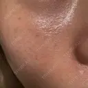 ルメッカ 博多美容外科/美容皮膚科 ビラビューティークリニック AFTER サムネイル用