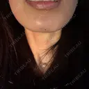 ボトックス（あご） / ヒアルロン酸注入（あご） 博多美容外科/美容皮膚科 ビラビューティークリニック AFTER サムネイル用