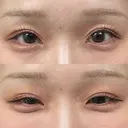 ヒアルロン酸注入（涙袋） 小倉美容外科/美容皮膚科 ビラビューティークリニック DAY 3 サムネイル用