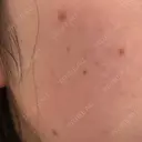 ほくろ・いぼ除去レーザー（肌） 心斎橋KT美容クリニック DAY 4 サムネイル用