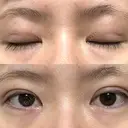 二重埋没 / 上まぶたの脂肪取り アリエル美容クリニック 郡山院 DAY 35 サムネイル用