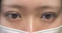 二重埋没 EMMA CLINIC（エマクリニック） DAY 1 サムネイル用