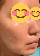 肌育注射（ジュベルックなど） 城本クリニック 豊橋院 DAY 10 サムネイル用