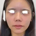 ヒアルロン酸注入（涙袋） / ヒアルロン酸注入（唇） / ヒアルロン酸注入（鼻翼基部） DMTC CLINIC 日本橋院 AFTER サムネイル用