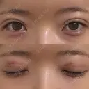 二重埋没 コスメディカルクリニック シンシア 銀座院 DAY 4 サムネイル用