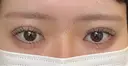 二重埋没 EMMA CLINIC（エマクリニック） DAY 2 サムネイル用