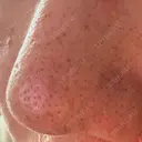 アグネス 日本美容・医療クリニック 六本木院 AFTER サムネイル用