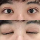 二重切開 / 目頭切開 / ほくろ・いぼ切除（肌） / 上まぶたたるみ取り / 上まぶたの脂肪取り 東京美容外科 銀座院 DAY 53 サムネイル用