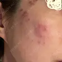 プラセンタ注射 / シミ取りレーザー S-Laboクリニック 渋谷院 DAY 1 サムネイル用