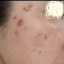 プラセンタ注射 / シミ取りレーザー S-Laboクリニック 渋谷院 DAY 2 サムネイル用