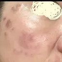 プラセンタ注射 / シミ取りレーザー S-Laboクリニック 渋谷院 DAY 0 サムネイル用