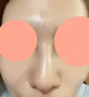 ヒアルロン酸注入（鼻） 博多美容外科/美容皮膚科 ビラビューティークリニック DAY 0 サムネイル用