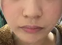 ハイフ（顔） Natural Skin Clinic 自由ヶ丘院 DAY 1 サムネイル用